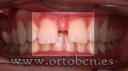 Diastema