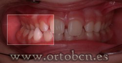 Oclusion cruzada Posterior