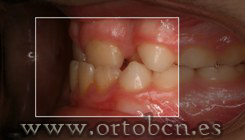 Oclusion cruzada anterior